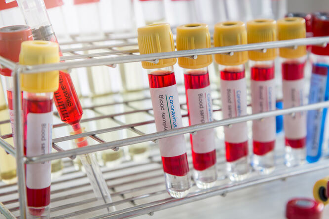 Jednostavan test krvi može pomoći  u utvrđivanju rizika od moždanog udara ili kognitivnog oštećenja